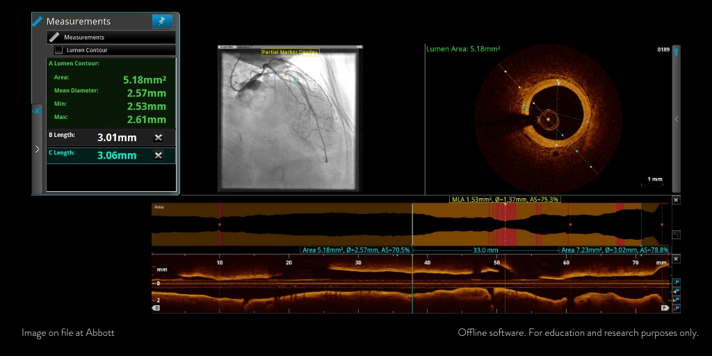 PCI Optimization case with step-by-step guidance