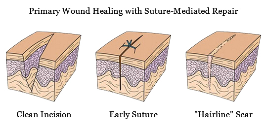 Perclose ProGlide™ suture-mediated repair promotes healing and decreases time to hemostasis