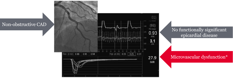 Angina and negative angiogram could mean CMD