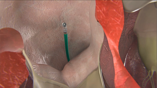 rendered image of FlexAbility ablation catheter in use