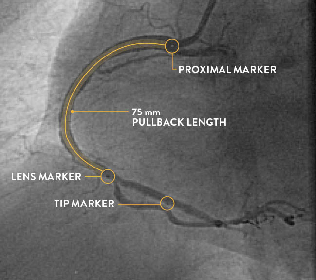 Dragonfly OpStar imaging catheter marker location compared to Dragonfly OPTIS imaging catheter