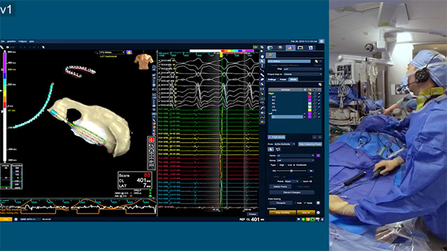 VT mapping with advisor HD grid mapping catheter video