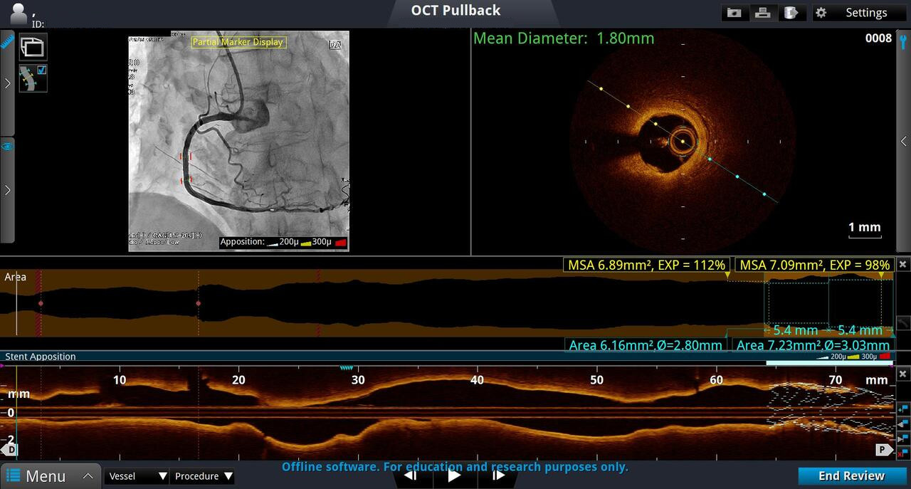 Screenshot showing RCA Distal Position