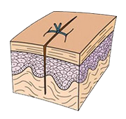 Early Suture