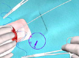 EOP Suture Management