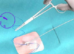 EOP Suture Management