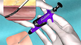 Single Suture Deploy