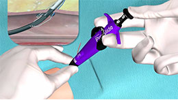 Single Suture Deploy