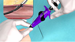 Single Suture Deploy