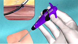 Single Suture Deploy