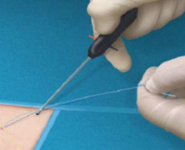 Suture Management