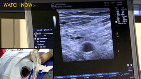 Ultrasound access