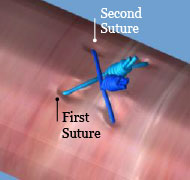  advance sutures in order of deployment