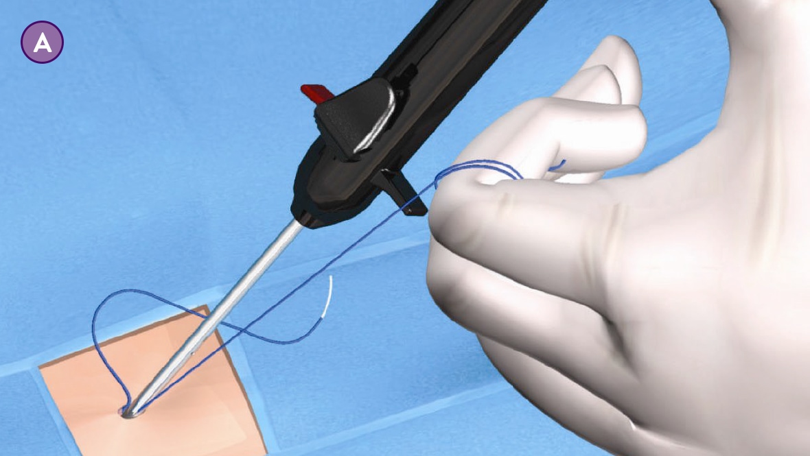  Suture Management Step A