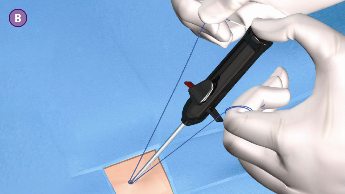   Suture Management Step B