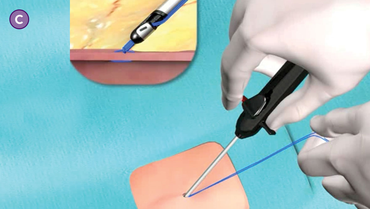   Suture Management Step C