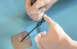 Suture Management