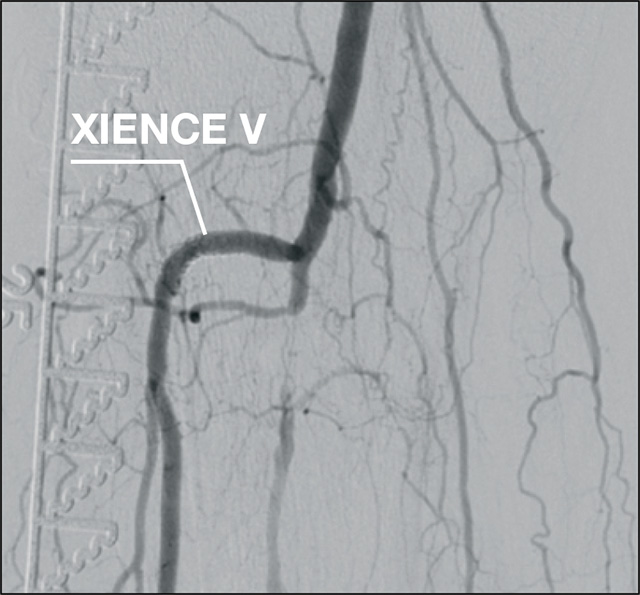 Xience Prime BTK Post-procedure