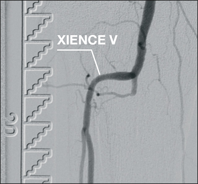 Xience Prime BTK 12 Months Post-procedure