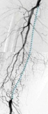 Complex Lesion