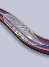 Stent 2