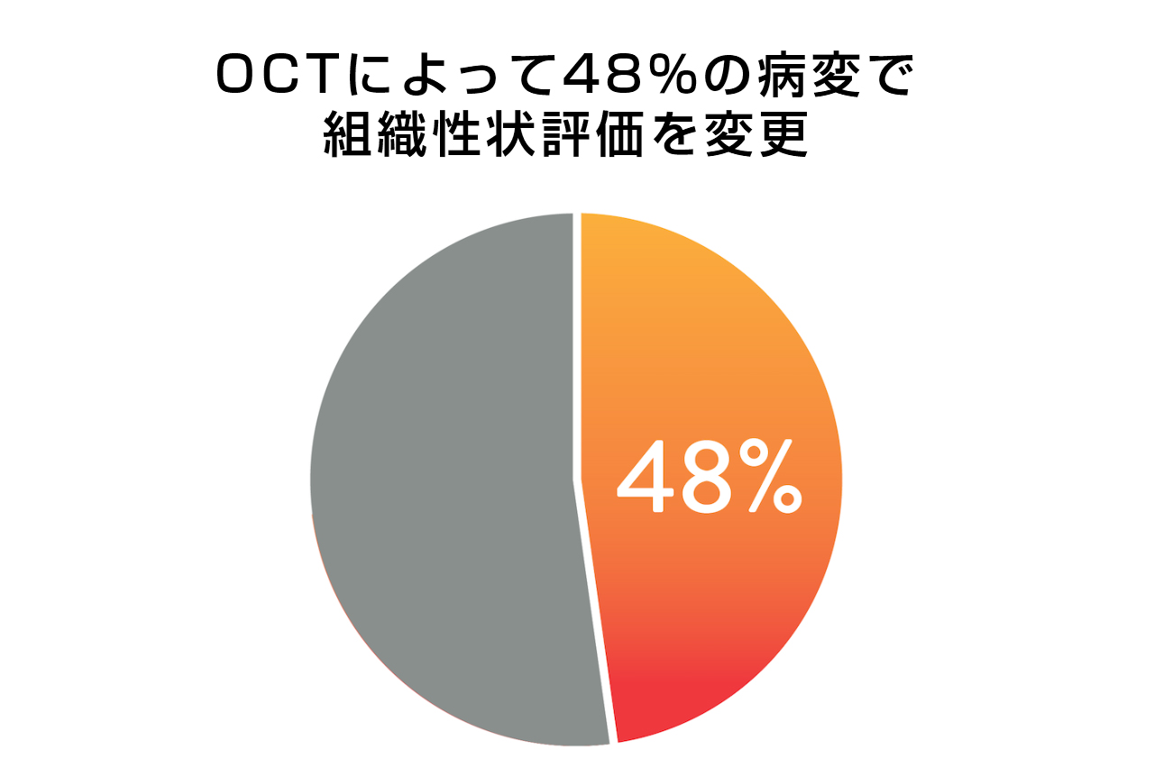 OCTによって48％の病変で組織性状評価を変更