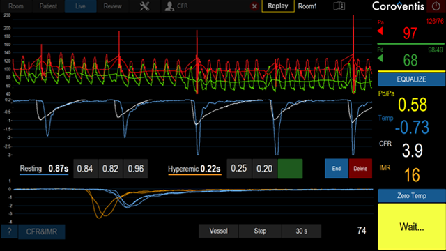 機能について | CoroFlow‡ Cardiovascular System | 冠内圧測定