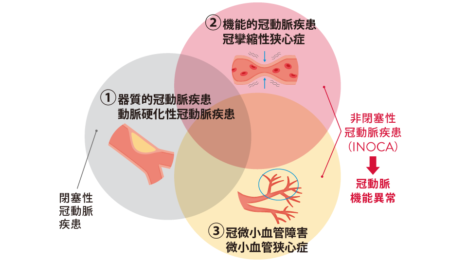 冠微小循環障害