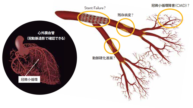 冠微小循環障害（CMD）