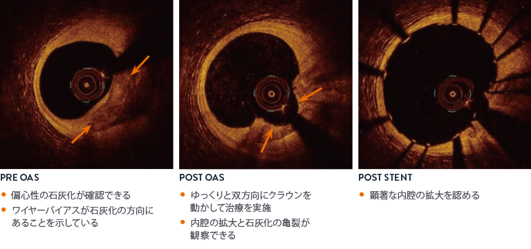 OCT Imaging