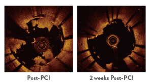In AMI patients, XIENCE Stent has a larger lumen area, less thrombus, and better strut coverage 2 weeks post PCI vs post PCI.