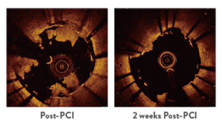 xience stent