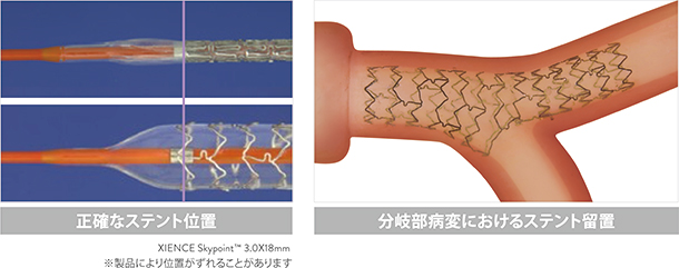 Stent Position disclaimer