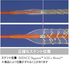 Stent Position disclaimer