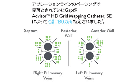 30 total gaps missed by pacing were identified by the Advisor HD Grid Mapping Catheter, SE.