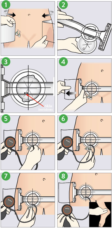 FemoStop II Plus deployment 