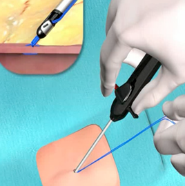 suture management step three