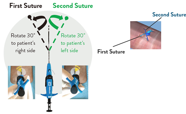 perclose prostyle two