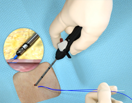suture management step three