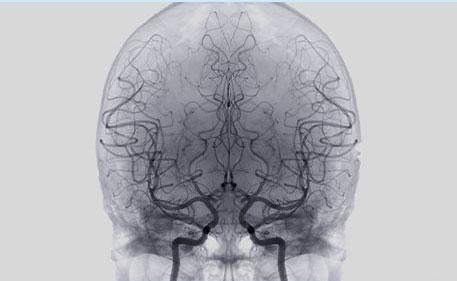 Cerebral Angiography