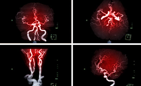 Magnetic Resonance Angiography