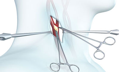 Carotid Endarterectomy