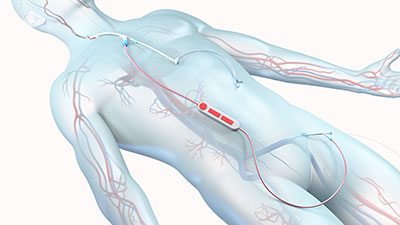 Transcarotid Artery Revascularization