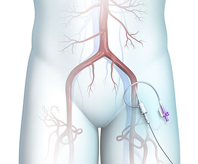 Transfemoral Carotid Artery Stenting (TFCAS)