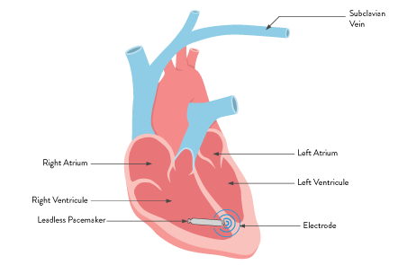 Heart illustration with pacemaker