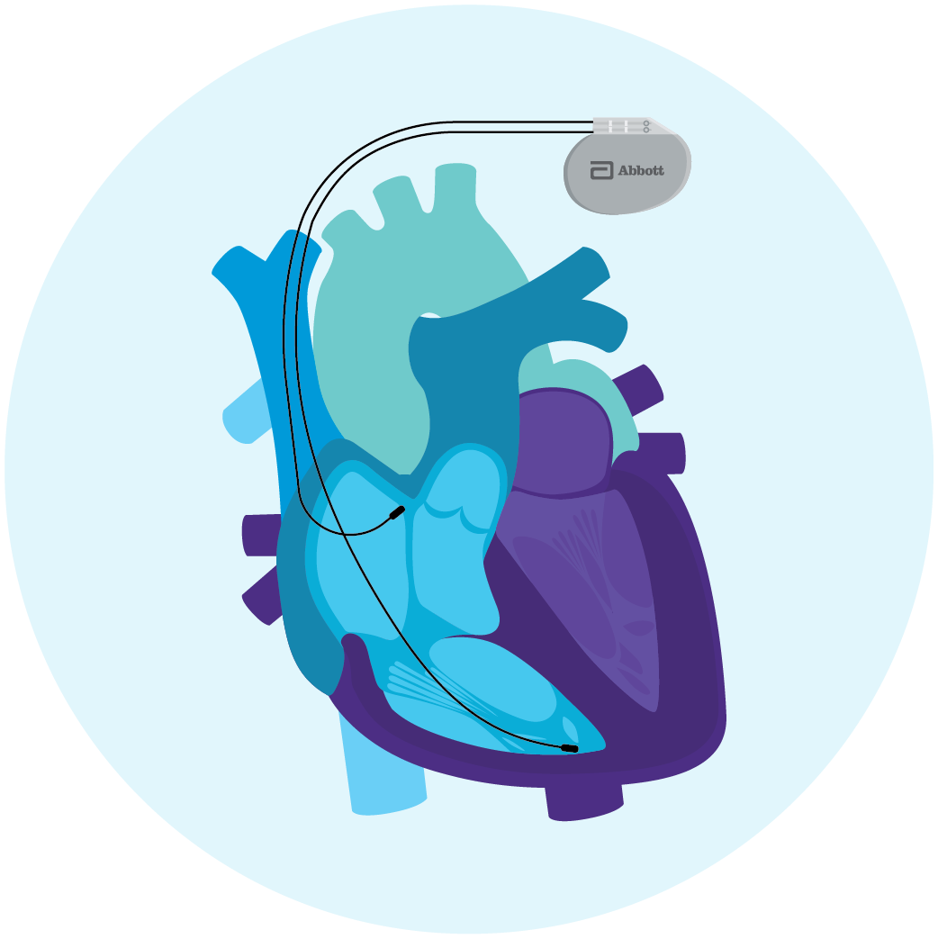 Heart illustration with pacemaker