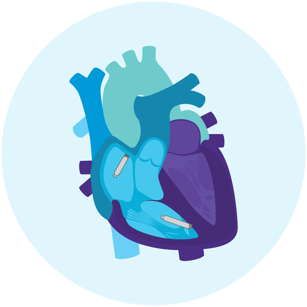 Heart illustration with pacemaker