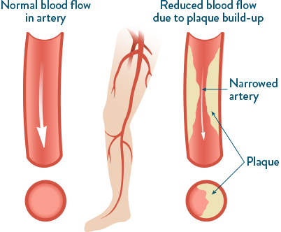 What is Peripheral Artery Disease (PAD)