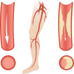 Symptoms of Peripheral Artery Disease (PAD)