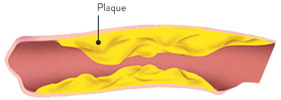 Plaque in arteries